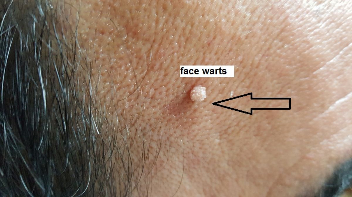 My Warts Story face warts case