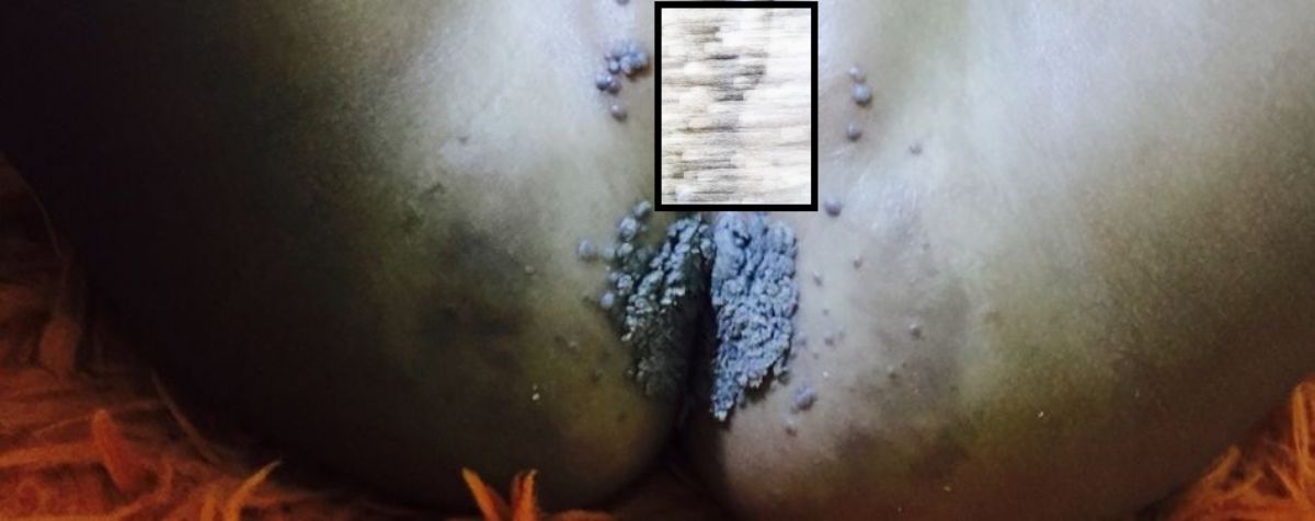 A child with a severe case of genital warts infection