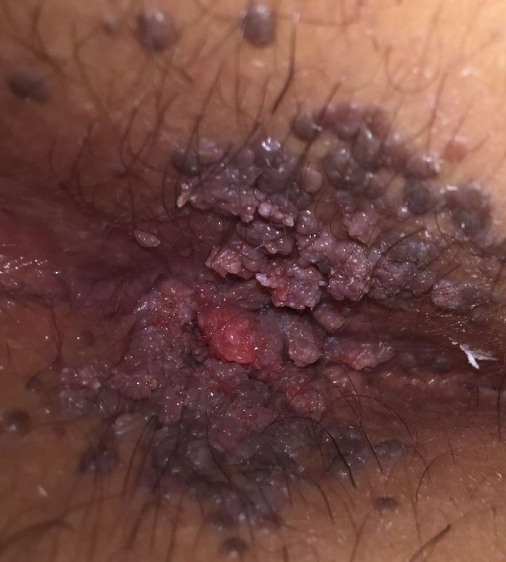 Baby Born With Warts On Anal Area - Anus genital picture wart - Nude Images