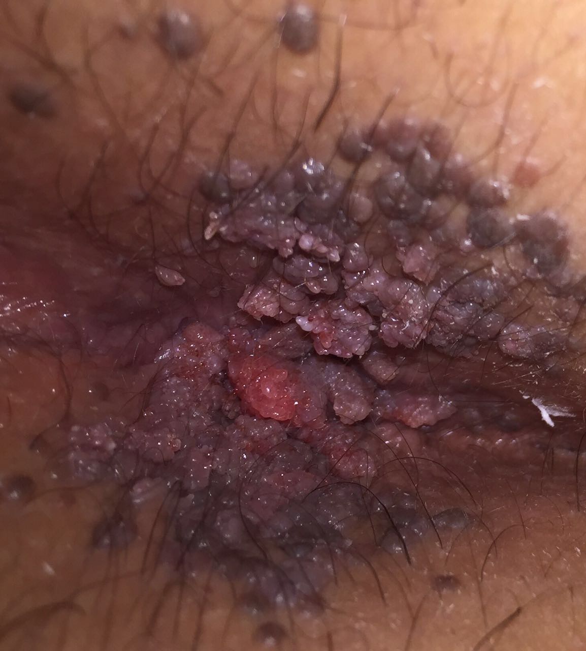 1 anal warts  befor treatment