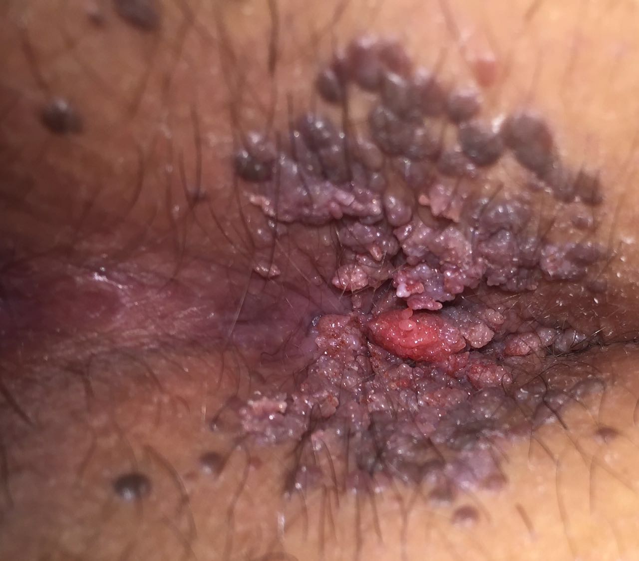 stages photo Anal warts