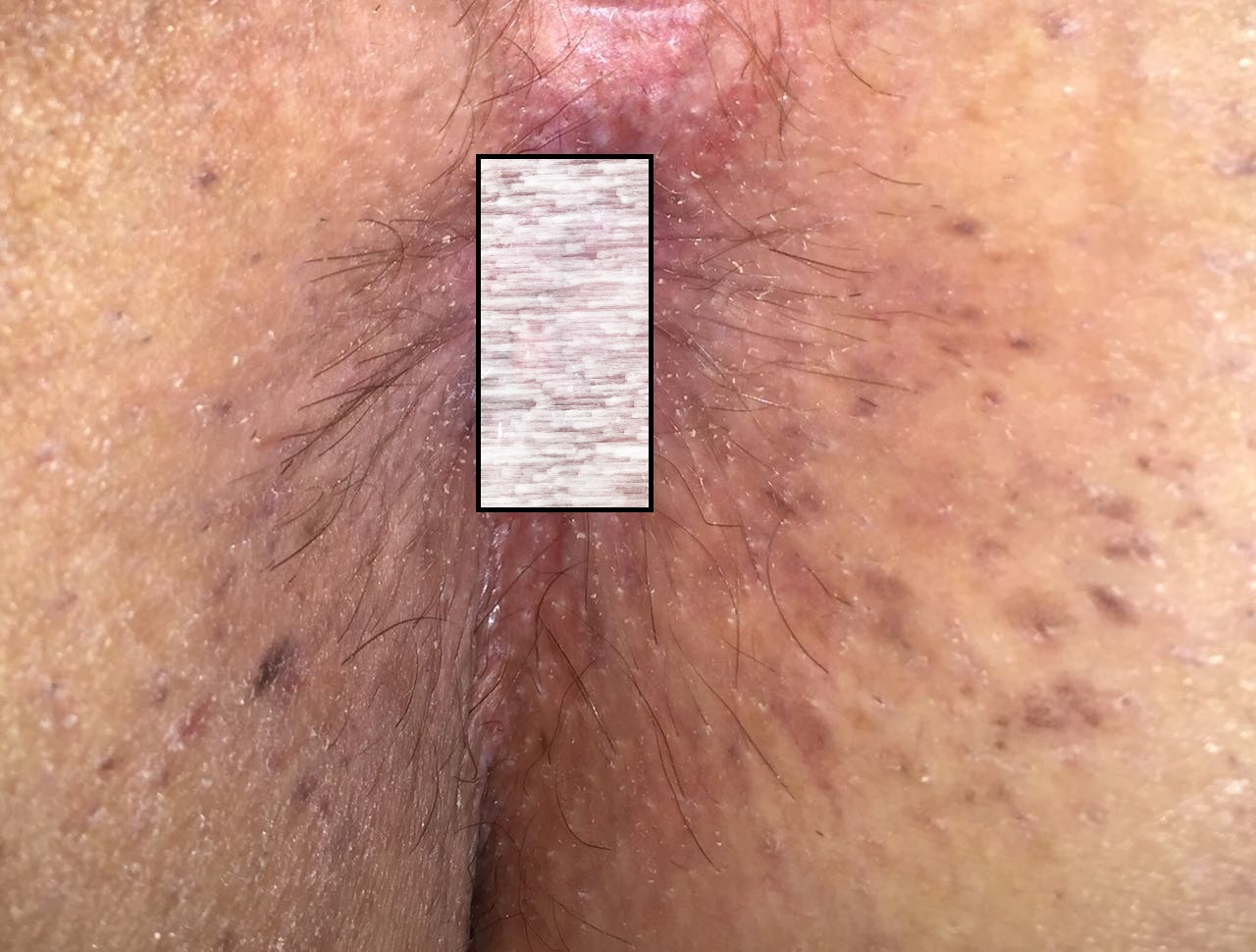 anal warts  after treatment
